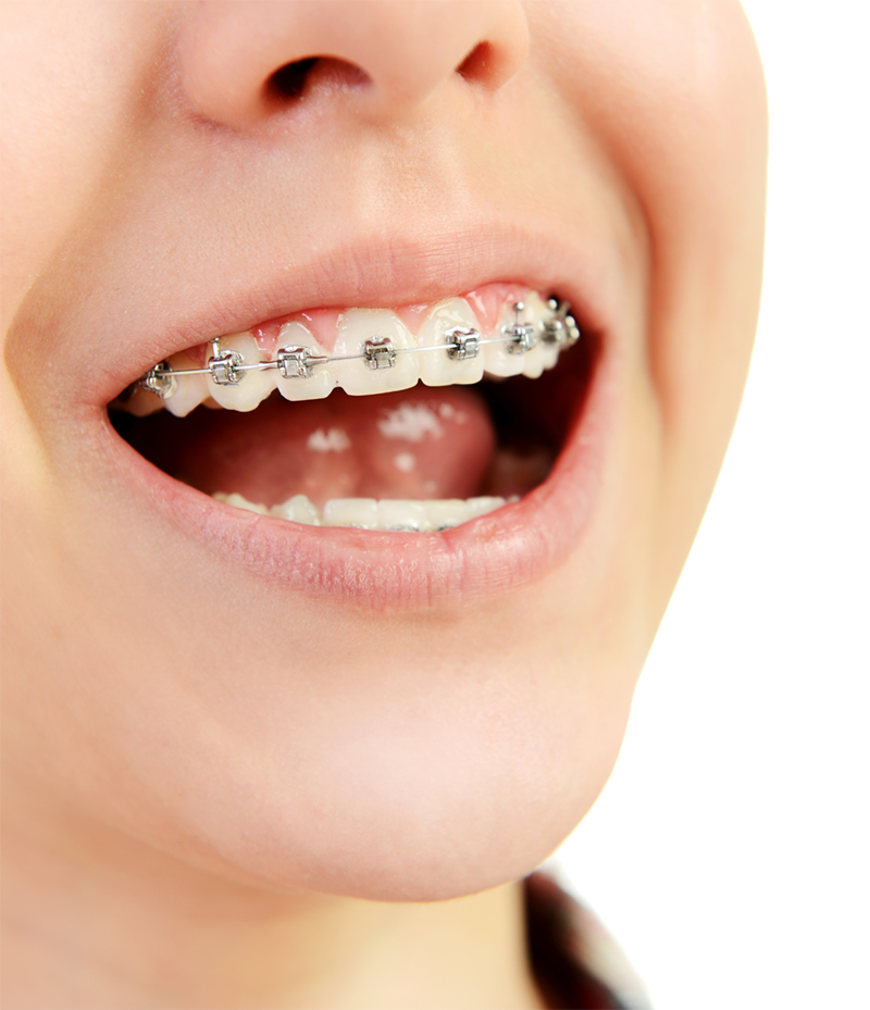 Adult Braces: What Are the Options? Edmonton, AB