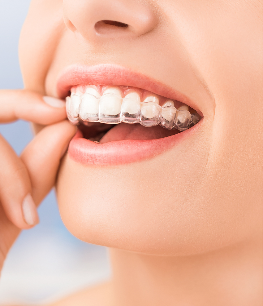 Dental Braces for a Perfect Smile - Verve Orthodontics